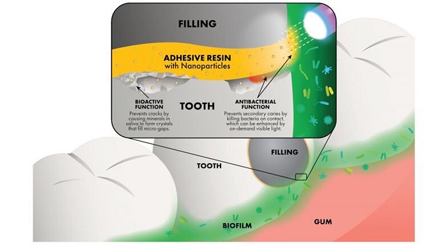 چسب پلیمری نانویی برای کمک به دندان‌پزشکان