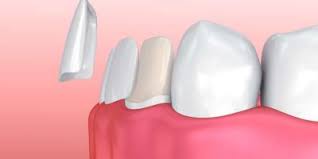 پلیمرهای کامپوزیت دندانی